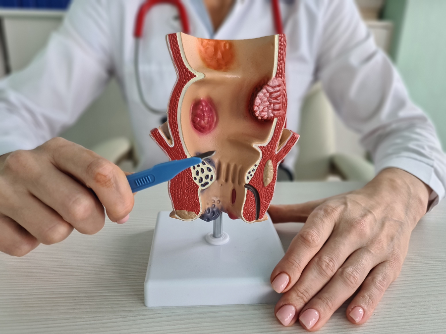 Cytologia kanału odbytu – skuteczna profilaktyka raka, o której wciąż mówi się za mało!
