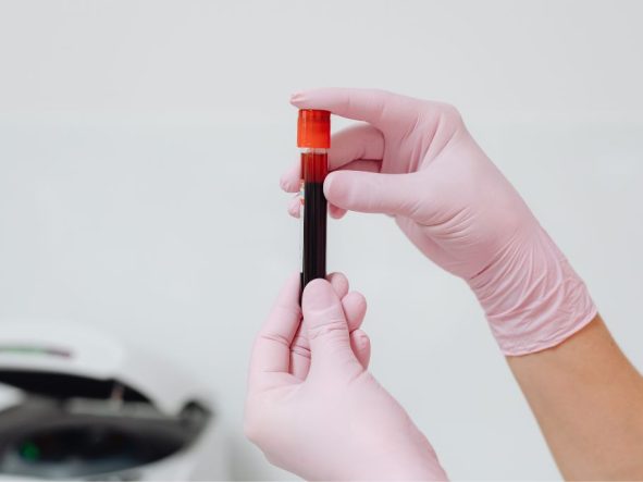 Androstendion – ważne badanie hormonalne