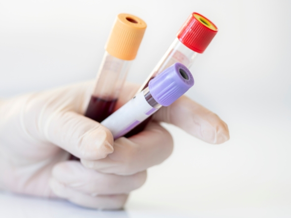 Morfologia krwi – co oznaczają skróty na wyniku badania?