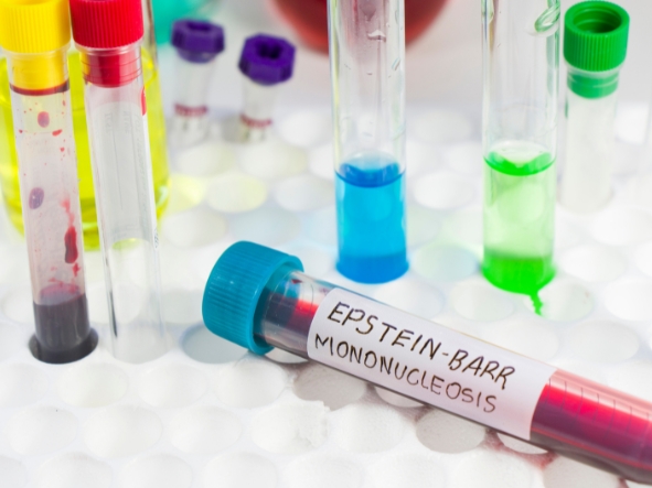 Wirus Epsteina-Barr (EBV) – jakie badania wykonać?